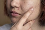 De ce antibioticele nu sunt soluția pentru tratarea acneei. Dar anticoncepționalele funcționează? Ce spun specialiștii