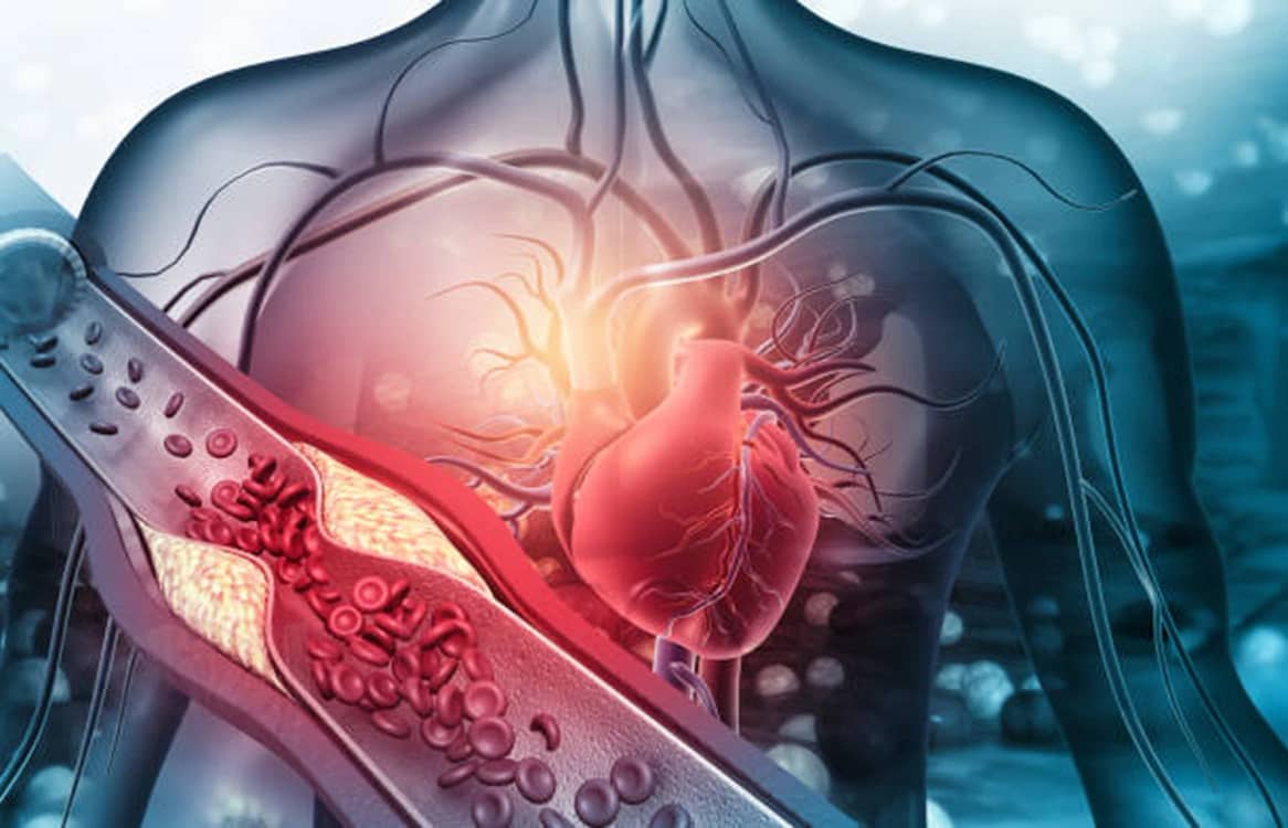Ilustrație care arată modul în care colesterolul poate afecta inima Sursă iStock