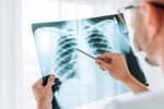 A crescut îngrijorător numărul cazurilor de cancer pulmonar la nefumători. Ce spun specialiştii despre principala cauză