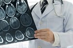 Studiu alarmant: 1 din 5 pacienți cu AVC minor va suferi un nou accident vascular cerebral în următorii 10 ani