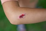 Boala infecțioasă gravă, cu mortalitate ridicată dacă nu este tratată rapid și corect. Sporii care o cauzează pot supraviețui ani de zile