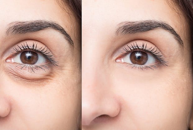 Dacă te trezești cu ochii umflați dimineața, iată adevăratul motiv și ce spune un dermatolog că trebuie să faci