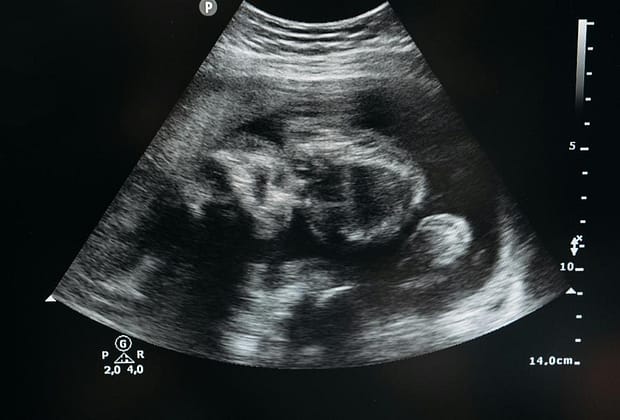 Ce este un lithopedion sau „bebelușul de piatră”? O raritate medicală care fascinează lumea