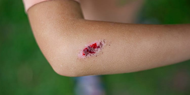 Boala infecțioasă gravă, cu mortalitate ridicată dacă nu este tratată rapid și corect. Sporii care o cauzează pot supraviețui ani de zile