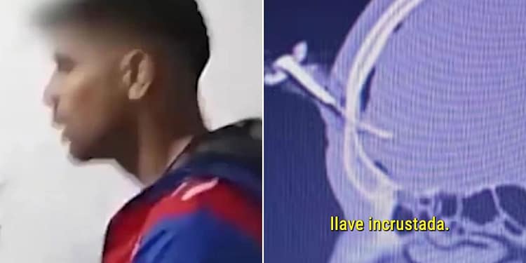 Operat pentru a-i fi extrasă o cheie de mașină înfiptă în cap! Imagini șocante